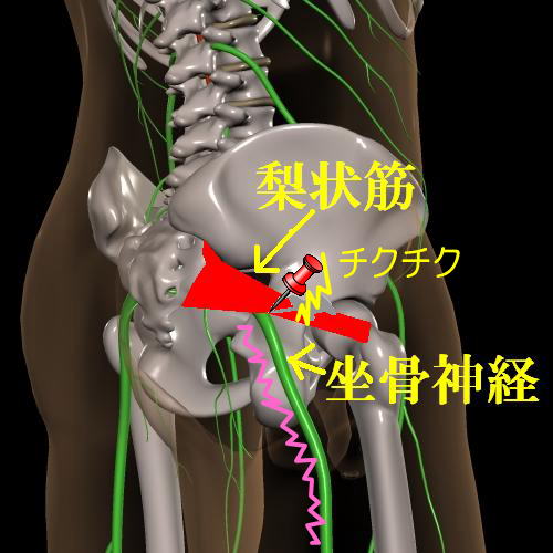 梨状筋の問題