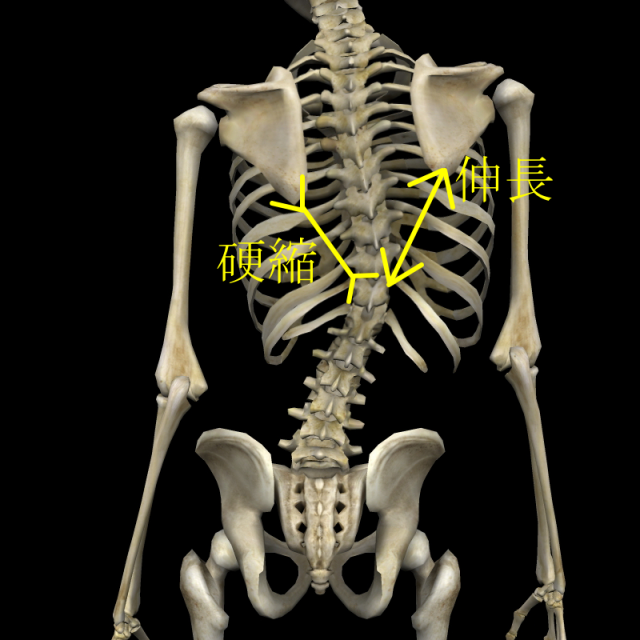 側弯症の脊椎