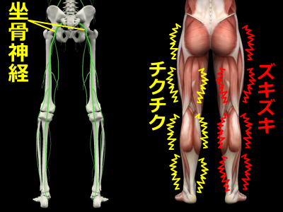 坐骨神経痛モデル図
