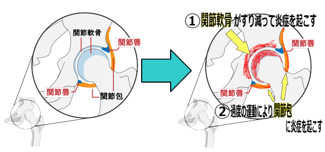 股関節炎症内部図