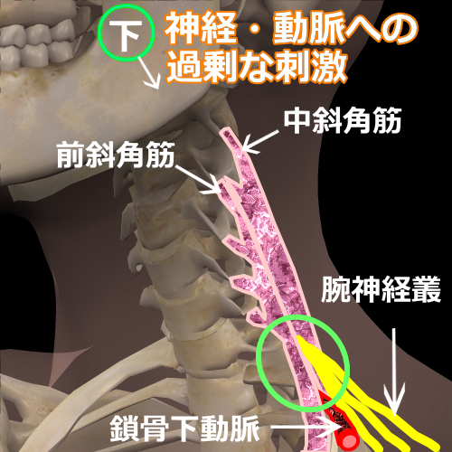 斜角筋症候群モデル図