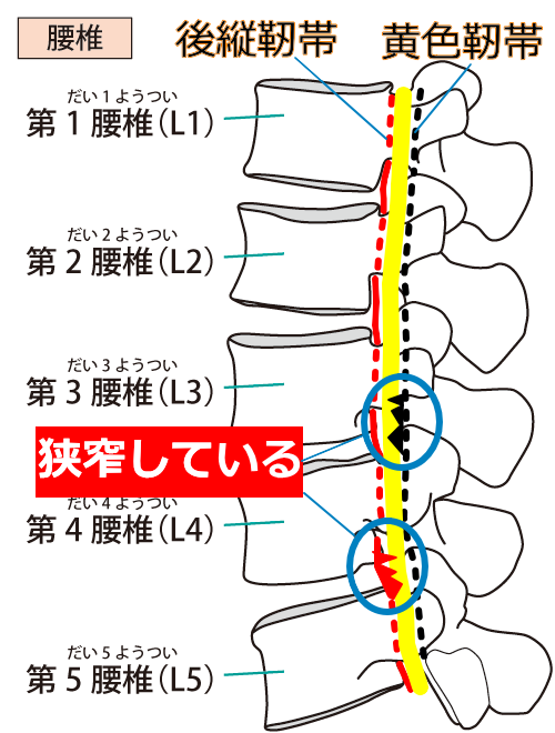 腰部脊柱管狭窄症モデル図