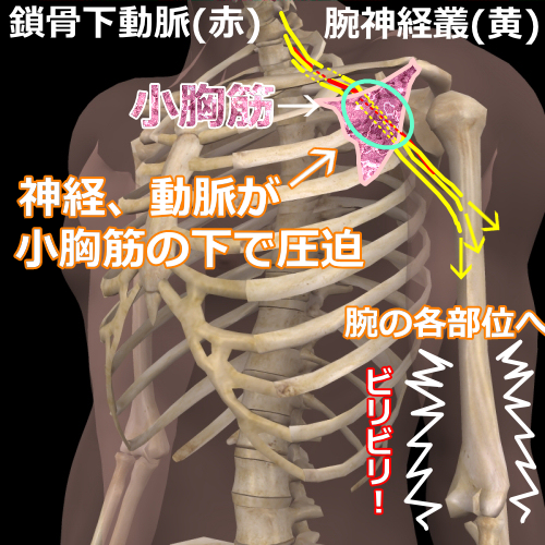 小胸筋症候群モデル図