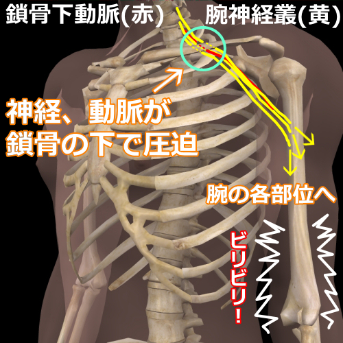 肋鎖症候群モデル図