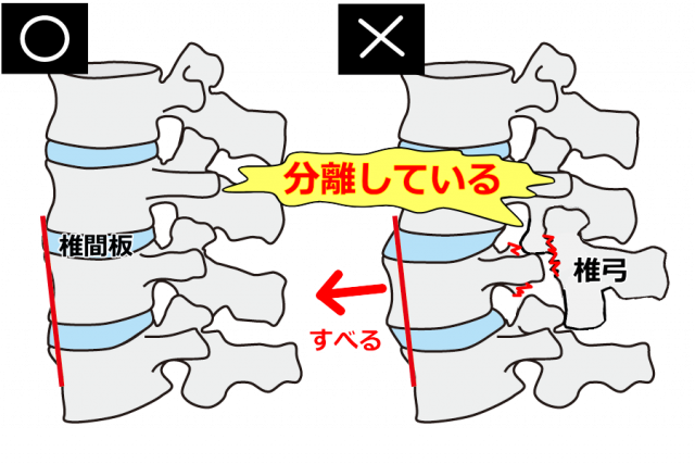 分離症モデル図