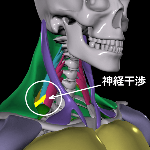 斜角筋症候群図